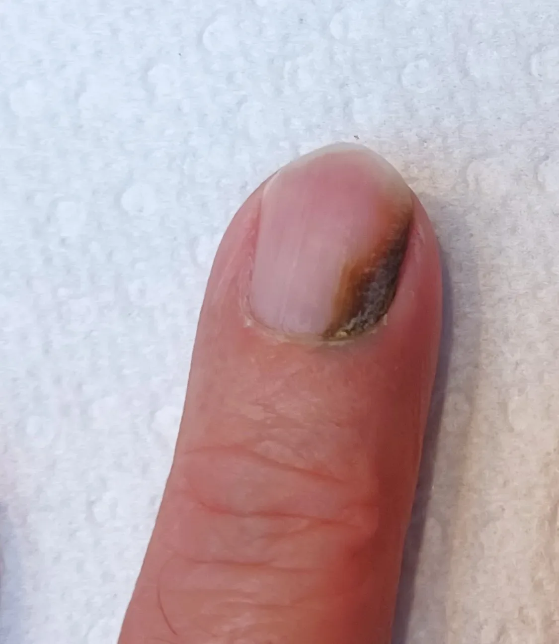 Is Green Nail Syndrome a Fungal Infection