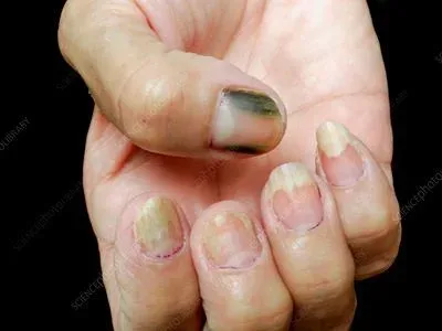 What Causes Green Nails and How Can They Be Treated
